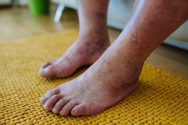 Essential tips to prevent diabetic foot complications now